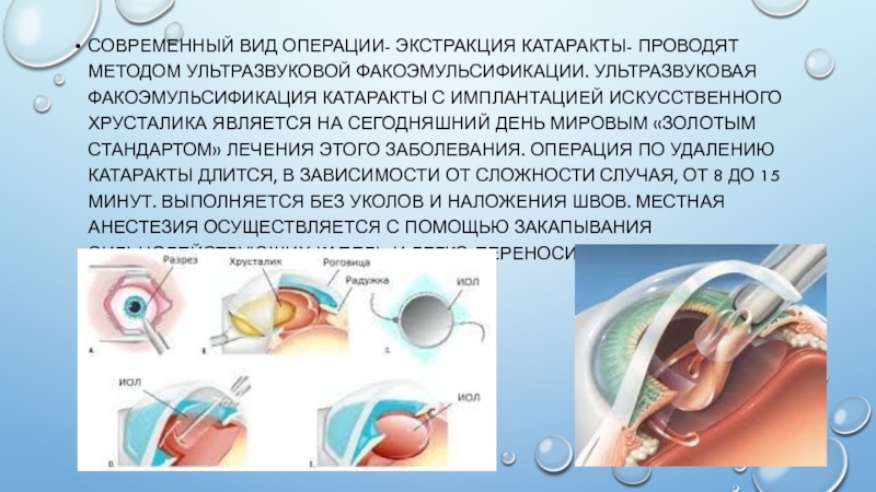 Катаракта операция clinicaspectr ru
