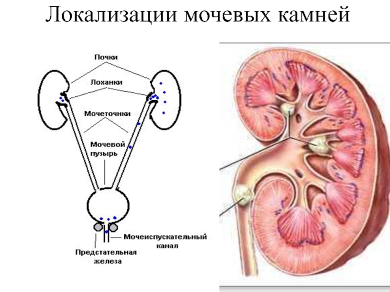 Схема выхода камня из почки у мужчин