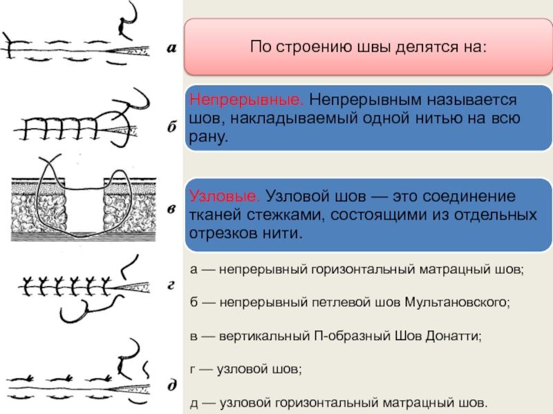 Х образный шов