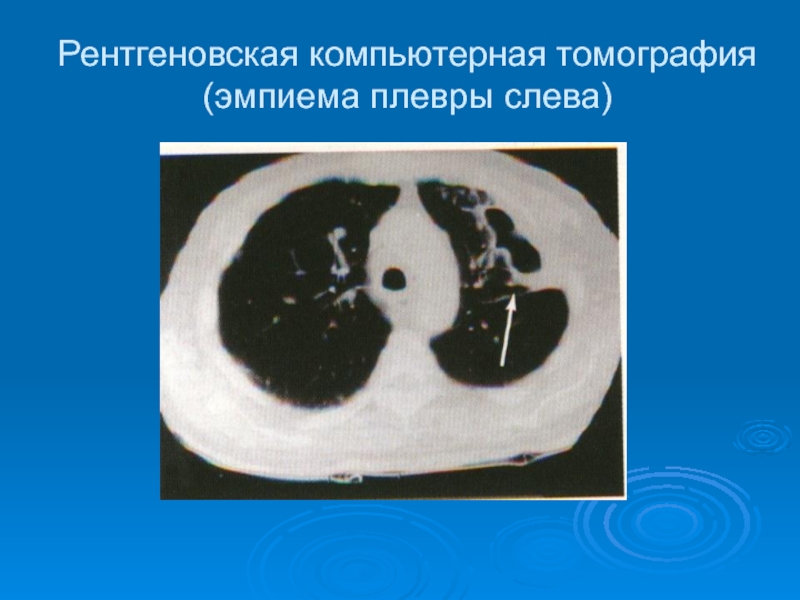 Рентгеновская компьютерная томография (эмпиема плевры слева)