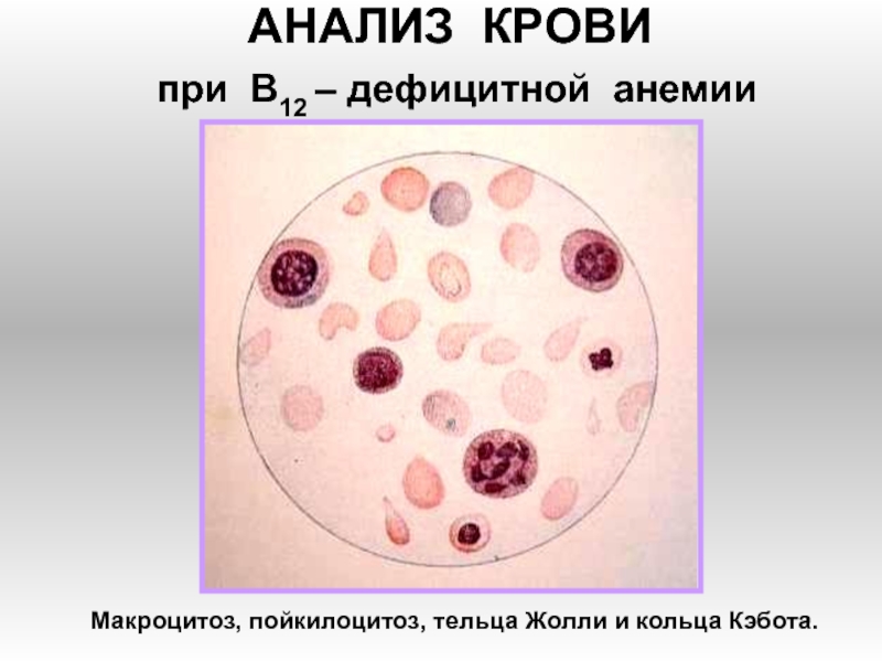 Презентация АНАЛИЗ КРОВИ при В 12 – дефицитной анемии
Макроцитоз, пойкилоцитоз, тельца