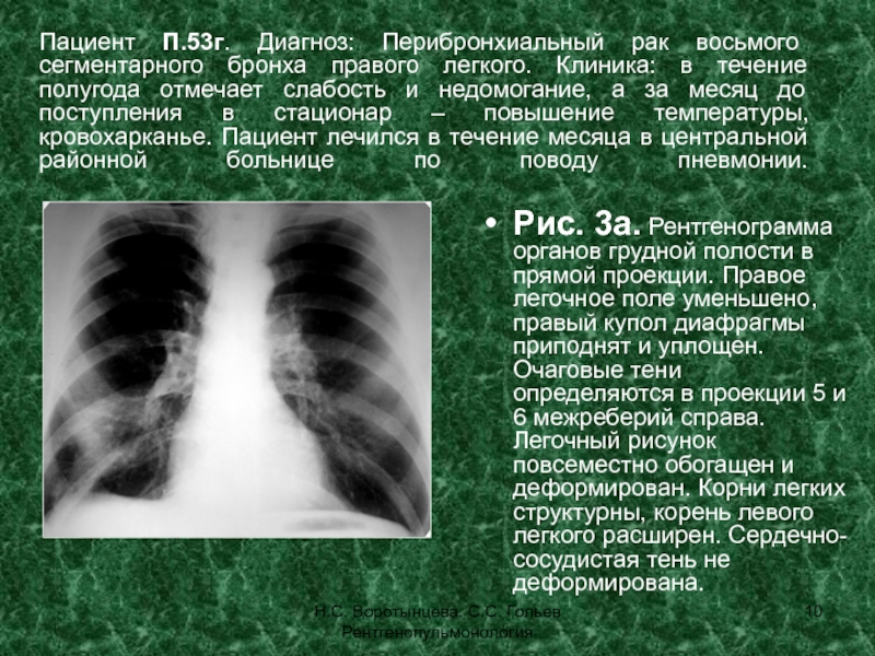 Легочный рисунок усилен деформирован корни