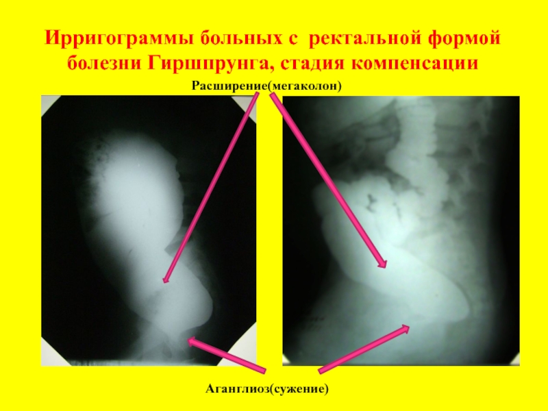 Клиническая картина ректальной формы болезни гиршпрунга характеризуется