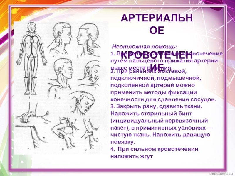 Пальцевое прижатие подключичной артерии производится. Пальцевое прижатие подключичной артерии. Место пальцевого прижатия подключичной артерии. Пальцевое прижатие подмышечной артерии.