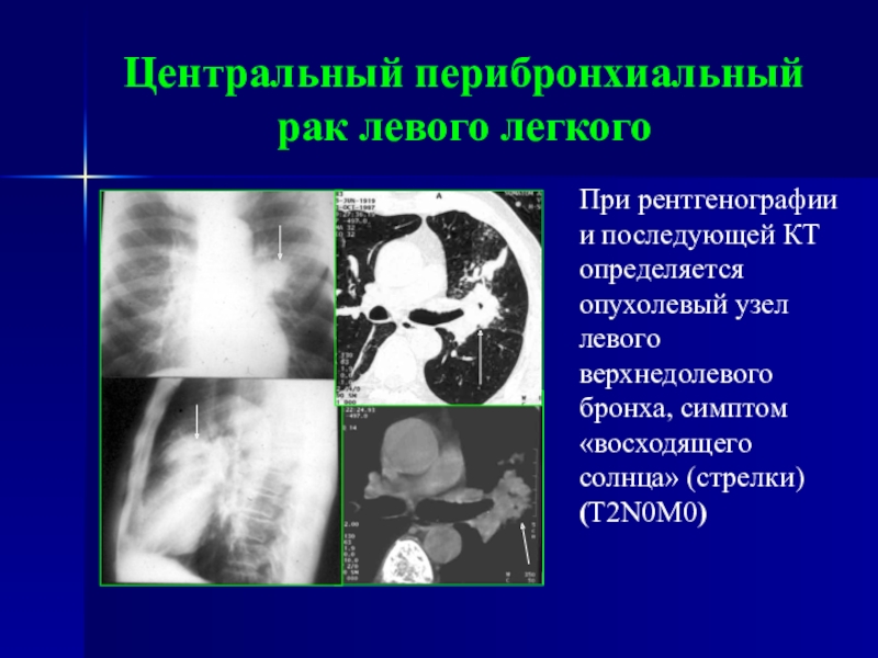 Центральный рак кт. Перибронхиальная опухоль. Карцинома лёгкого на кт. Перибронхиальные уплотнения кт.