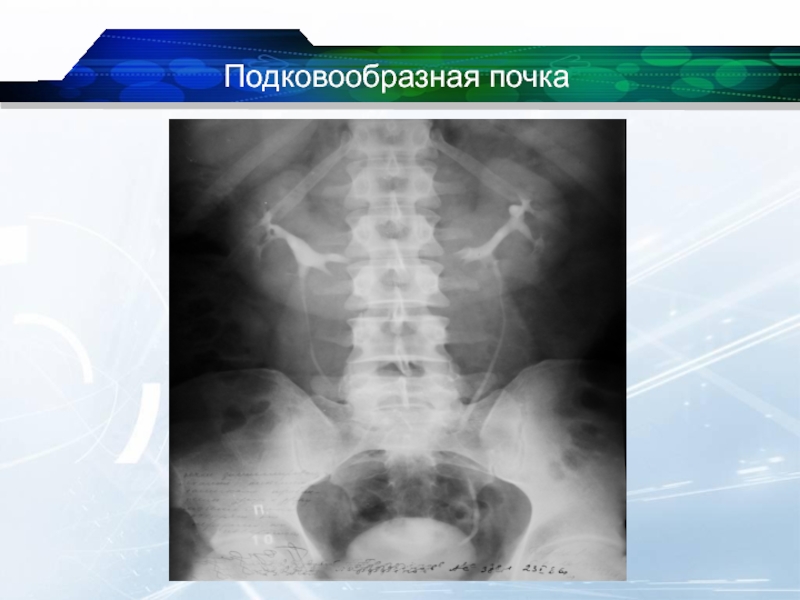 Аномалии почек презентация