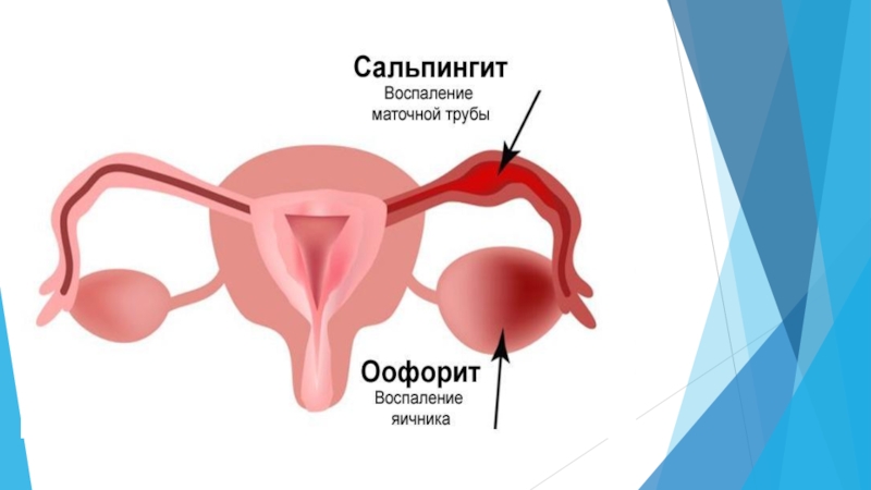 Реферат: Воспалительные заболевания женских половых органов неспецифической этиологии