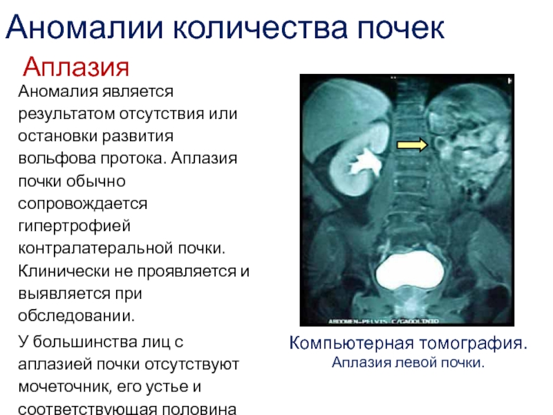 Аномалии мочеполовой системы презентация