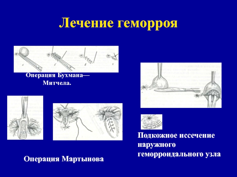 Схемы лечения геморроя