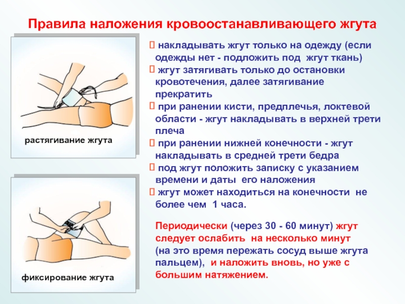 Наложение кровоостанавливающего жгута. Жгут кровоостанавливающий.