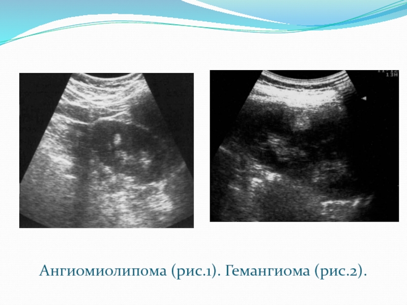 Ангиомиолипома. Описание ангиомиолипомы почки на УЗИ. Ангиомиолипома почки на УЗИ. Гемангиома ангиомиолипома. Ангиомиолипома правой почки УЗИ.