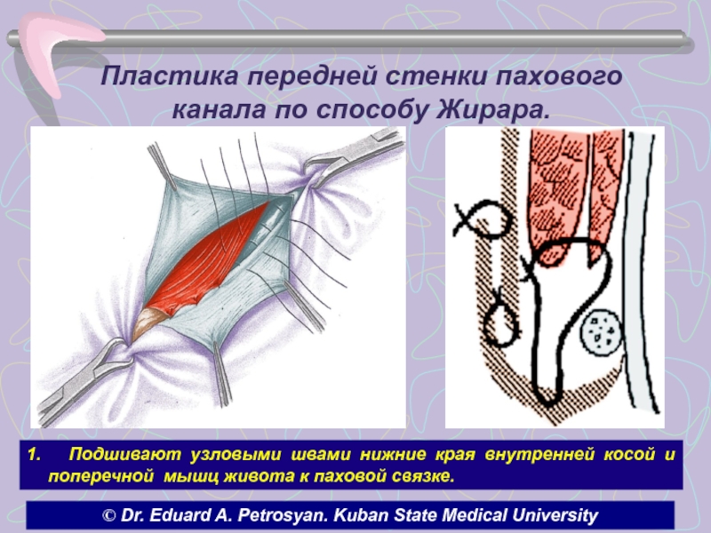 Пластика грыжи по мартынову