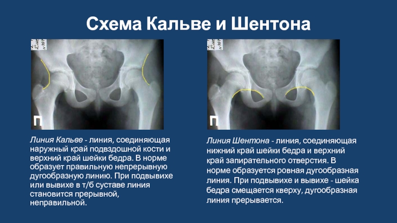 Схема хильгенрейнера тазобедренных суставов у детей