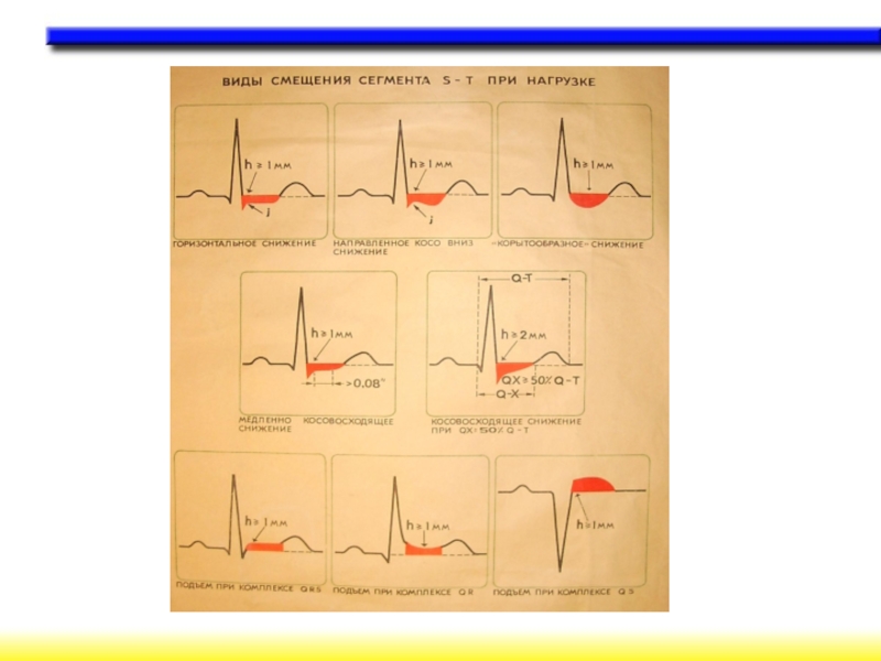 Сегмент st на экг. Корытообразный сегмент St на ЭКГ. Смещение сегмента St. Корытообразное смещение сегмента St. Смещение сегмента St на ЭКГ.
