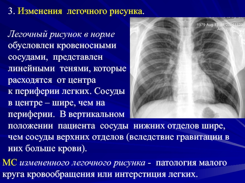 Легочный рисунок усилен в нижних отделах. Изменение легочного рисунка. Легочный рисунок. Легочный рисунок усилен. Расширение корня легкого на рентгене.