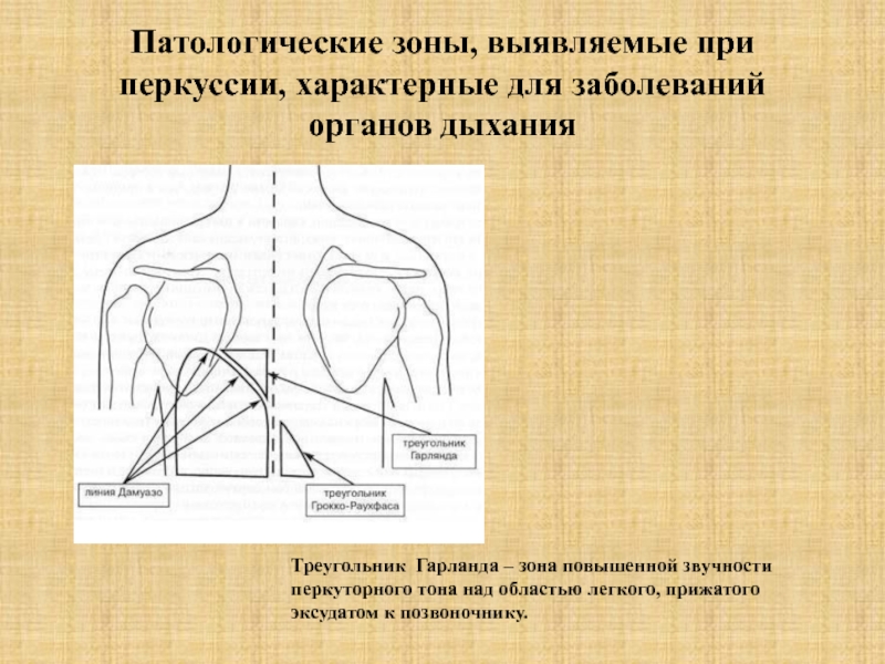 Перкуторная картина у больных с экссудативным плевритом