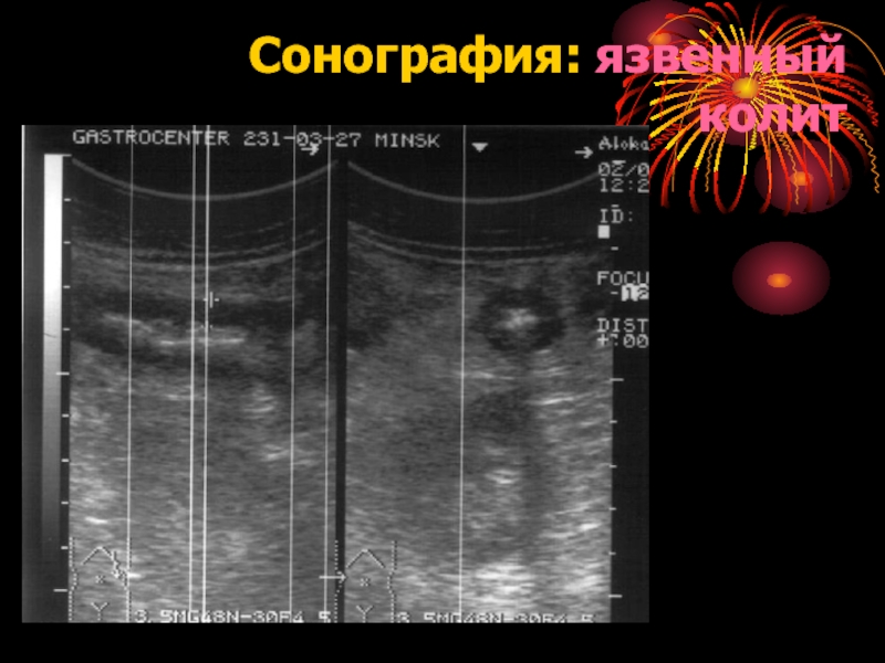 Сонография. Эндоскопическая сонография. Сонография позвоночника.