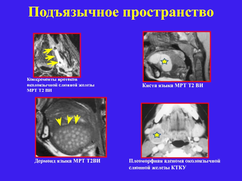 Лучевая диагностика заболеваний слюнных желез презентация