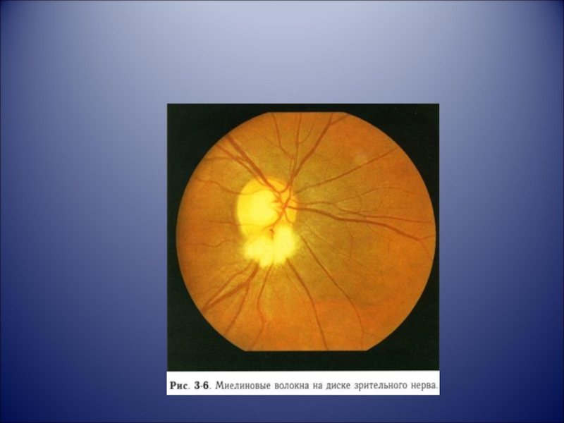 Аномалия развития зрительного нерва. Миелиновые волокна ДЗН. Глазное дно миелиновые волокна. Миелиновые волокна диска зрительного. Миелиновые волокна зрительного нерва.