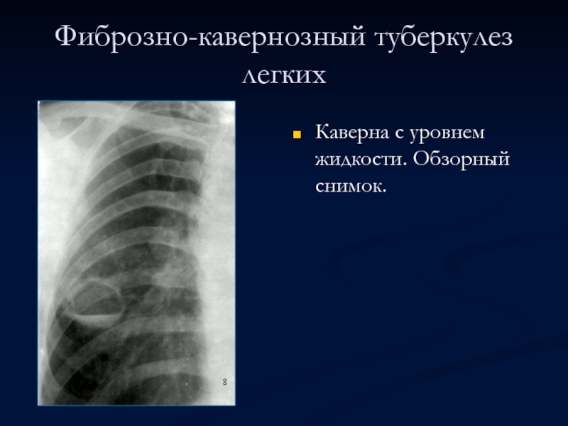 Фиброзно-кавернозный туберкулез легкихКаверна с уровнем жидкости. Обзорный снимок.