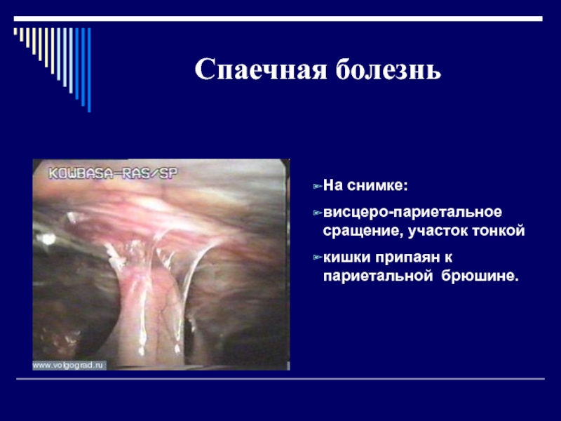 Реферат: Спаечная болезнь