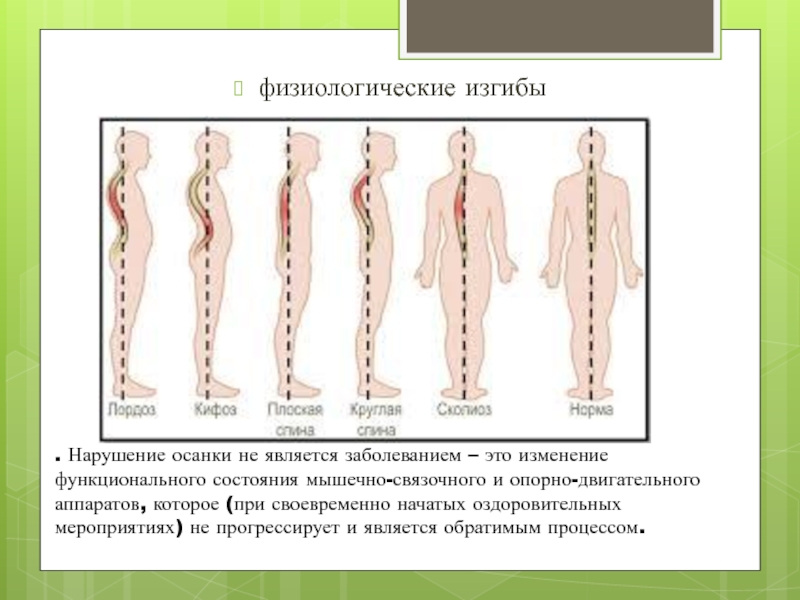 Нарушение осанки и плоскостопие. Плоскостопие и искривление позвоночника. Осанка и плоскостопие. Диагноз нарушение осанки.