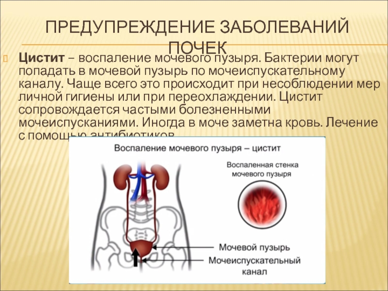 Заболевание почек цистит. Профилактика заболеваний мочевого пузыря. Бактерии в мочевом пузыре.