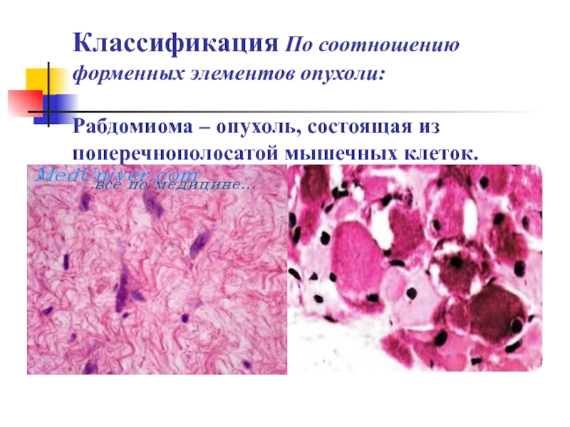 Классификация По соотношению форменных элементов опухоли:   Рабдомиома – опухоль, состоящая из поперечнополосатой мышечных клеток.