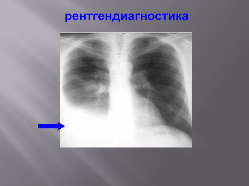 Рентгенологическая картина при экссудативном плеврите