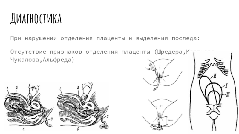 Признаки отделения плаценты