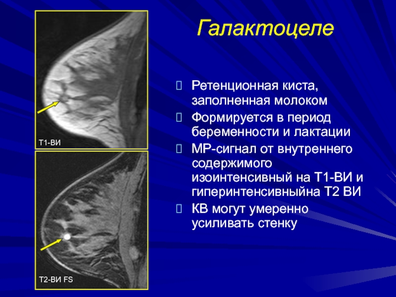 Шишка в грудной железе у женщин. Галактоцеле молочной железы на рентгене. Галактоцеле на маммографии. Галактоцеле молочной железы на УЗИ. Кисты в молочных железах.