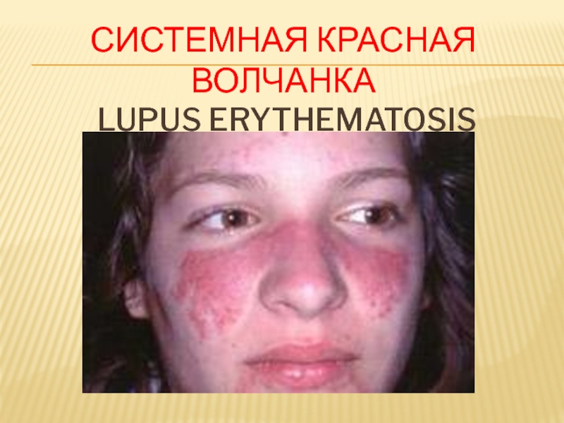 Презентация СИСТЕМНАЯ КРАСНАЯ ВОЛЧАНКА lupus erythematosis