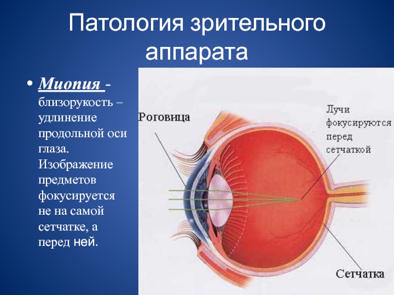 Если глаз человека строит изображение далеких предметов за сетчаткой то глаз