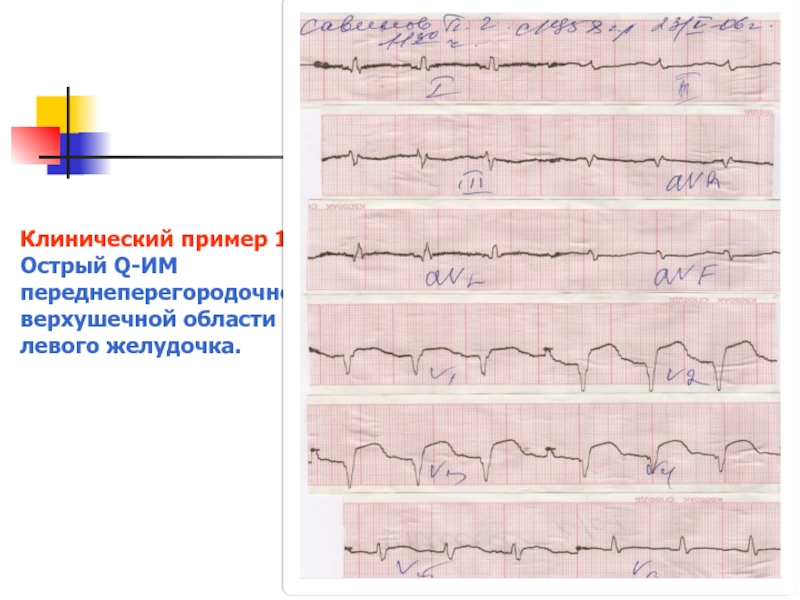 Ишемия на экг фото