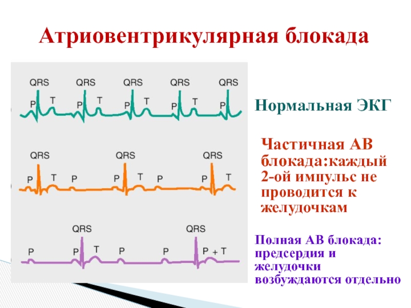 Блокада сердца