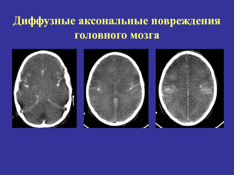 Диффузная травма головного. Диффузное аксональное повреждение мозга кт. Диффузно аксональные повреждения головного мозга кт. Диффузные аксональные повреждения головного мозга мрт. Диффузное аксональное повреждение кт и мрт.