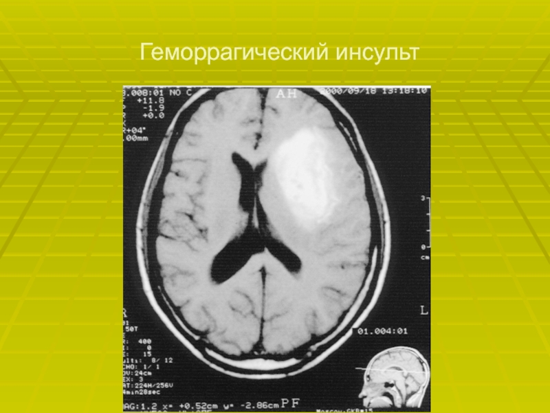 Геморрагический инсульт презентация