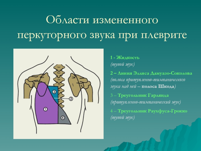 Перкуторная картина у больных с экссудативным плевритом