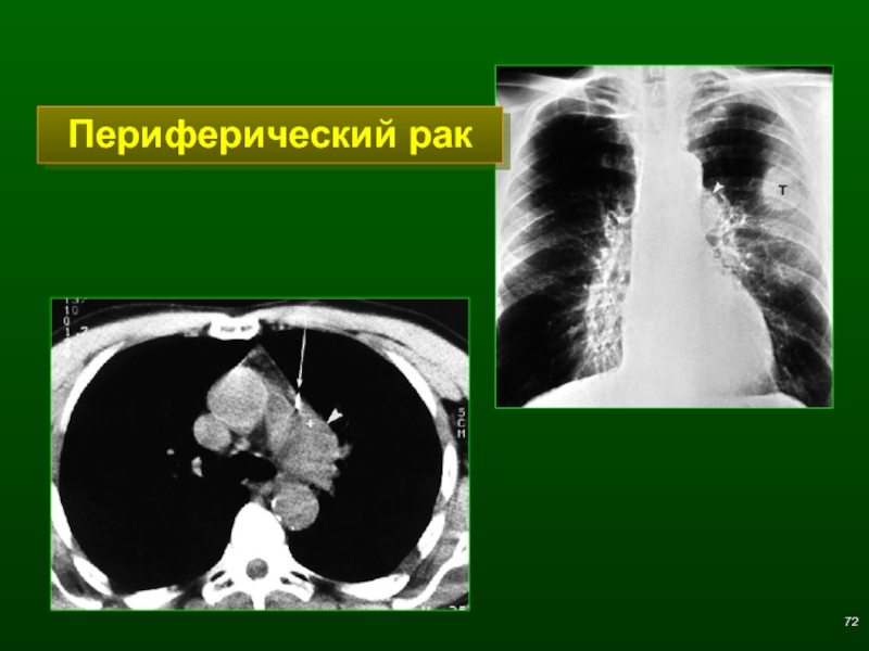 Диагноз периферический рак