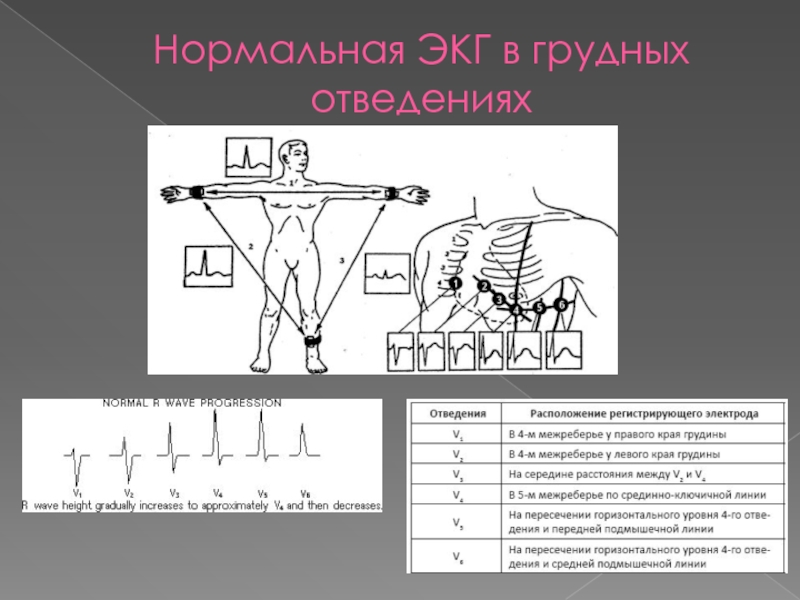 Экг правила наложения электродов