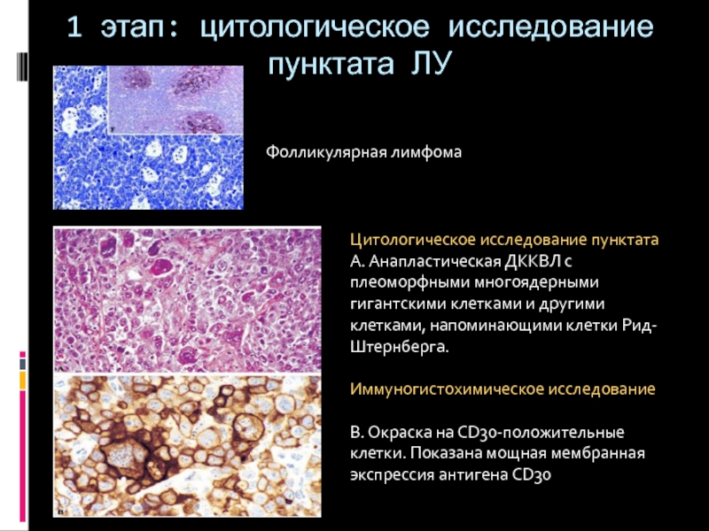 Цитологическая картина лимфомы