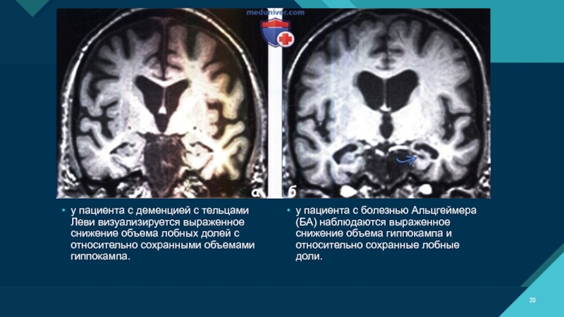 Лобно-височная деменция мрт. Деменция с тельцами Леви мрт. Деменция на мрт. Болезнь Альцгеймера мрт.