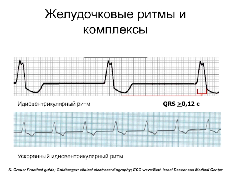 Ритм на экг. Желудочковый комплекс QRS на ЭКГ норма. Желудочковой комплекс QRST Длительность. ЭКГ желудочковый ритм 70. Желудочковый ритм ритм на ЭКГ.