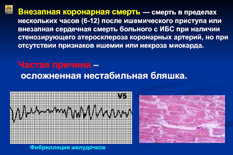 Ибс патологическая анатомия презентация