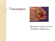 Токсокароз 