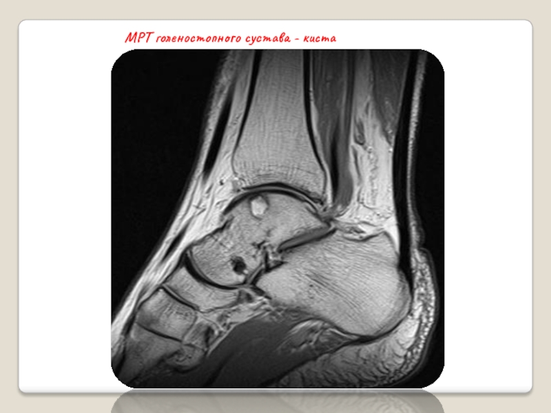 Мрт голеностопного сустава. Гигрома голеностопного сустава на мрт. Синовиальная киста голеностопного. Киста голеностопного сустава мрт.