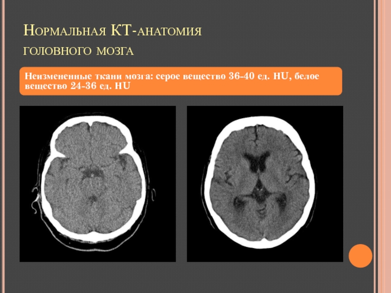 Гиперденсные структуры на кт изображениях