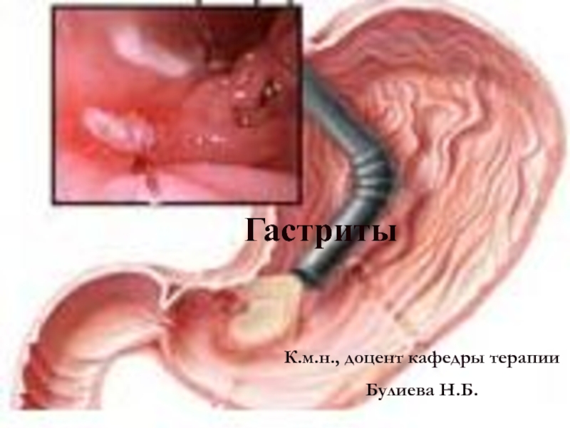 Гастриты
К.м.н., доцент кафедры терапии
Булиева Н.Б