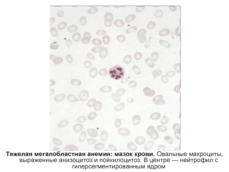 Тяжелая мегалобластная анемия: мазок крови. Овальные макроциты, выраженные анизоцитоз и пойкилоцитоз. В центре — нейтрофил с гиперсегментированным
