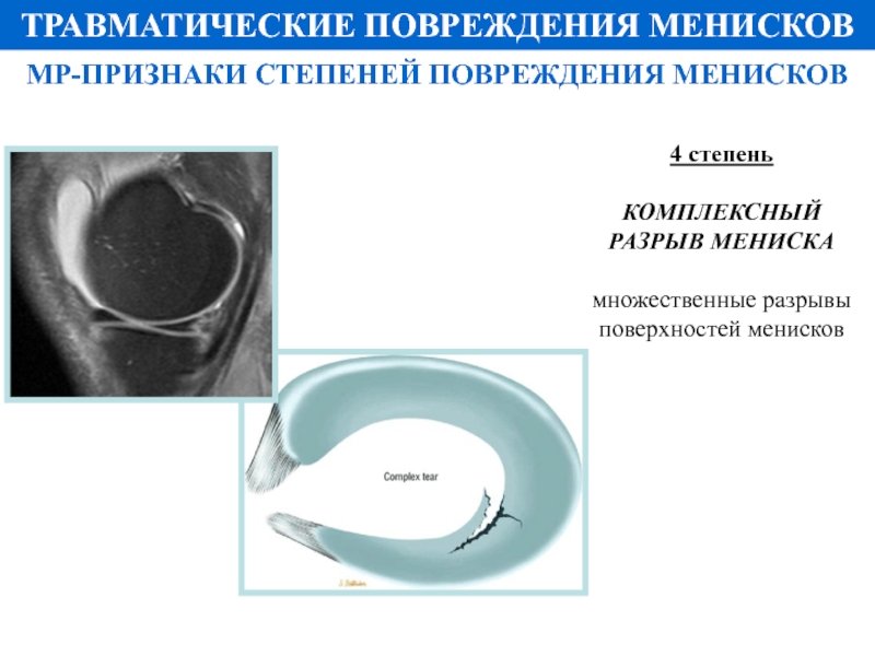 Мр картина повреждения внутреннего мениска 3а степени по stoller